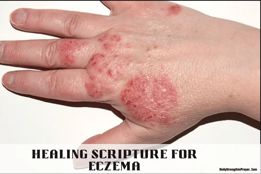 Healing Scriptures for Eczema